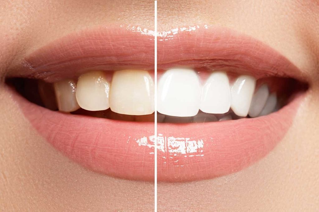 Teeth Whitening Advanced Dental Care of Anderson teeth whitening anderson