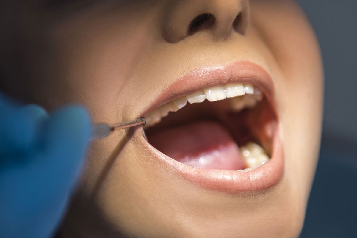 dental-extractions-anderson dental extractions anderson