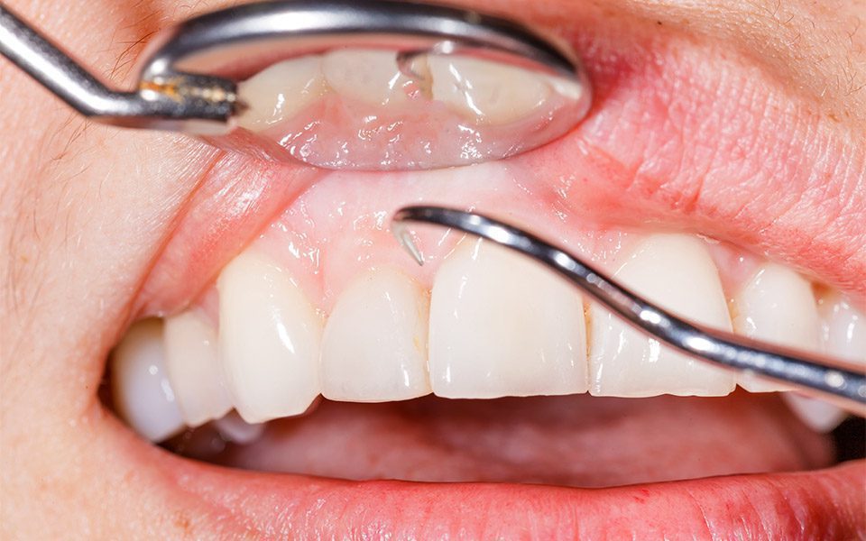 gum-disease-treatments-anderson gum disease treatments anderson