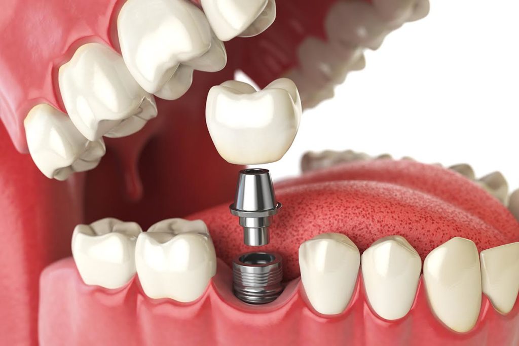 Tooth human implant. Dental concept. Human teeth or dentures. 3d illustration implants anderson