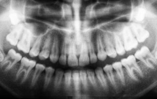 Why are oral cancer screenings important?