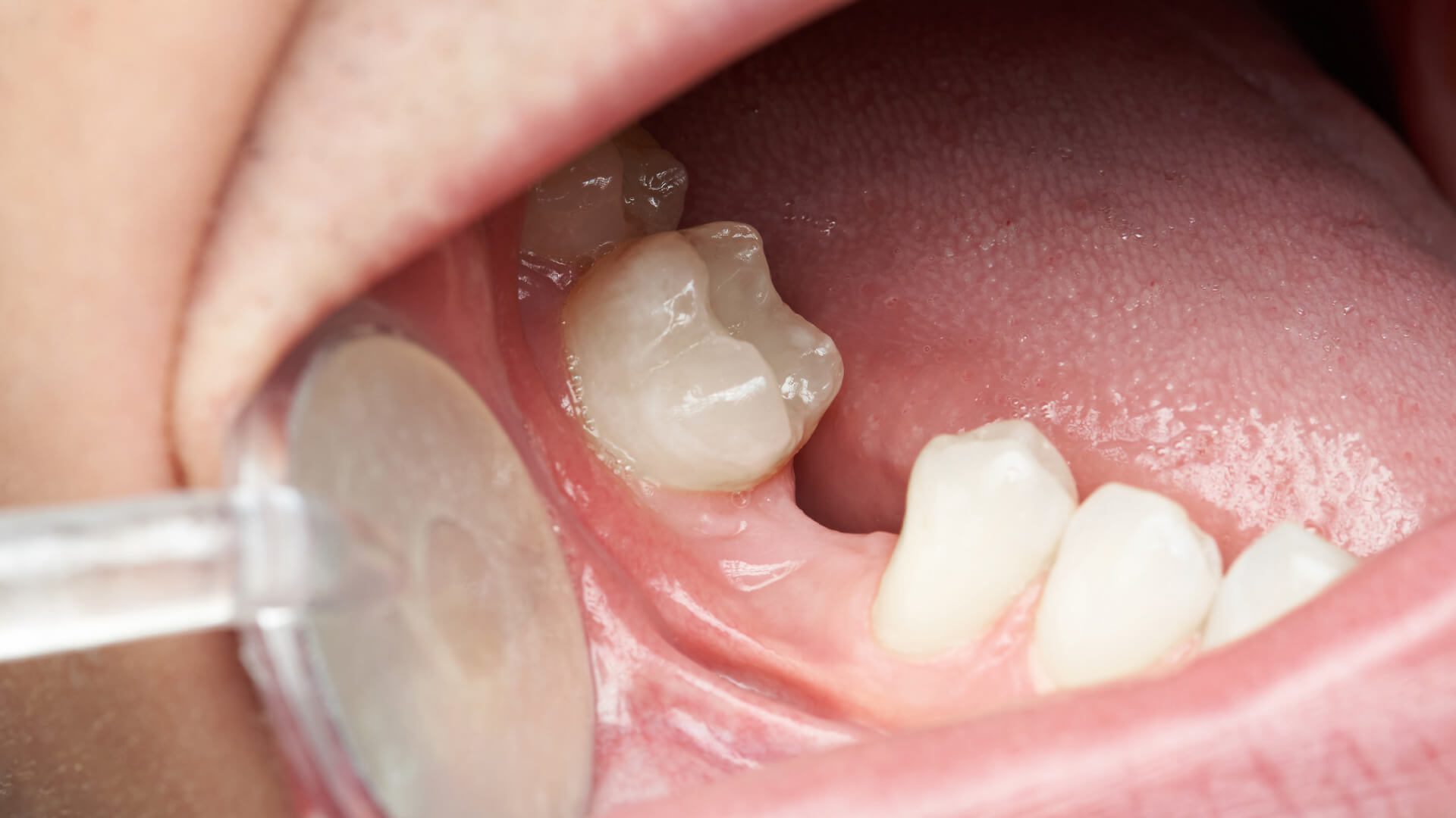 Dentures For 3 Teeth  - Excessive Vdo (= Too Little Vdr And Inadequate Resting Space).