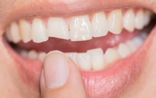 person trying to fix a broken tooth at home