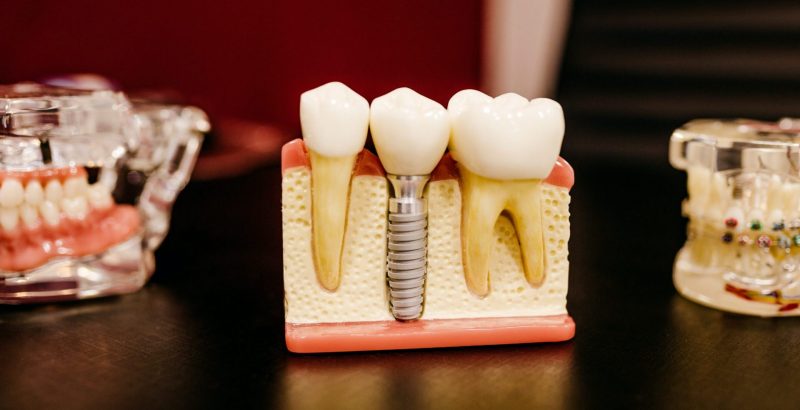 How To Fix A Broken Tooth At Home Advanced Indiana