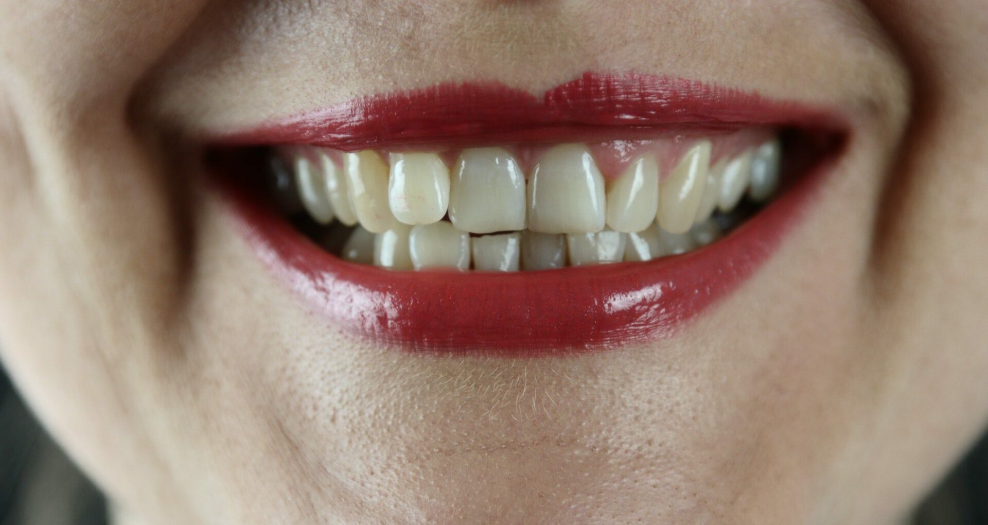 woman smiling with crooked teeth