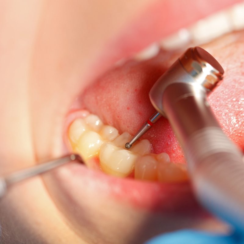 patient getting a filling