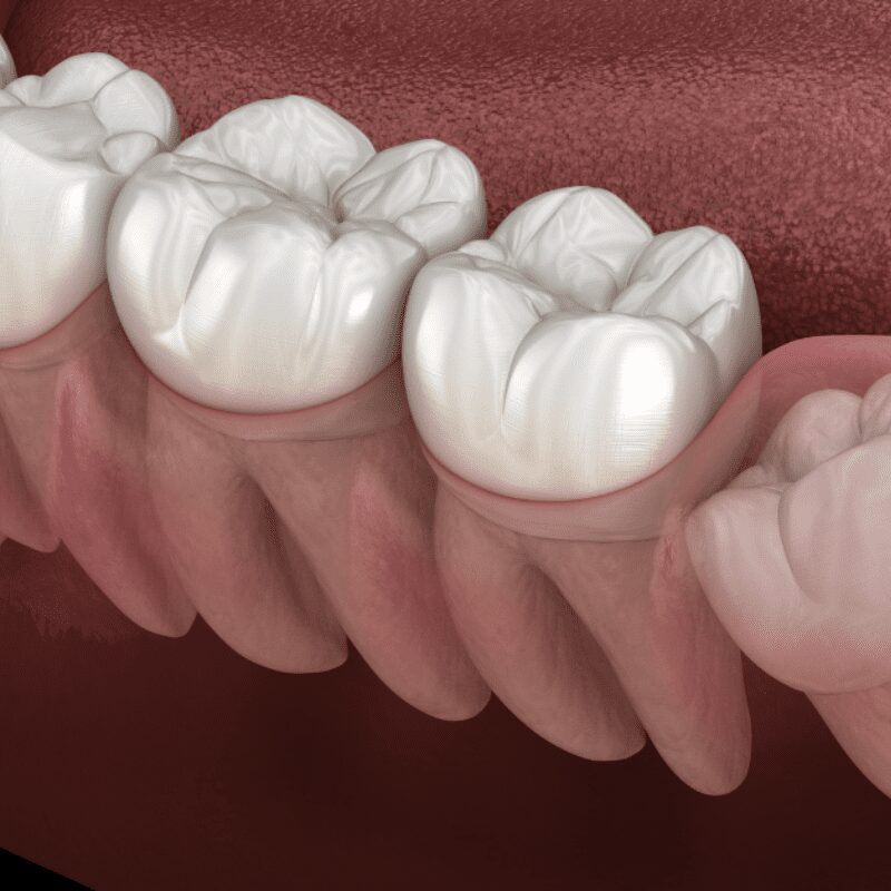 Wisdom Tooth eruption