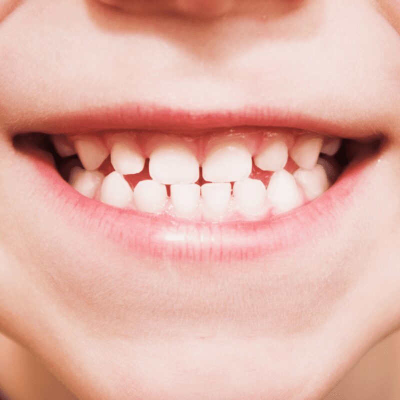 child smiling with teeth (1) child smiling with teeth