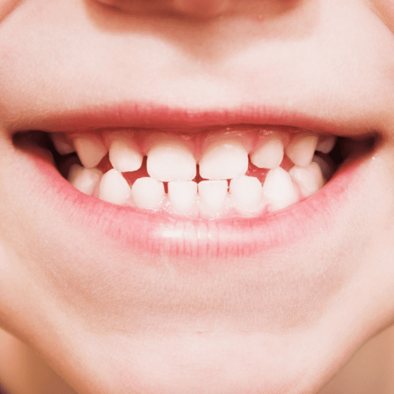 child smiling with teeth (1) child smiling with teeth