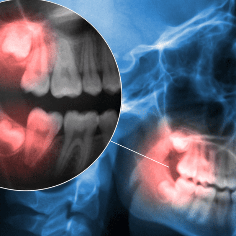 x-ray scan of tooth pain and joint pain x-ray scan of tooth pain and joint pain
