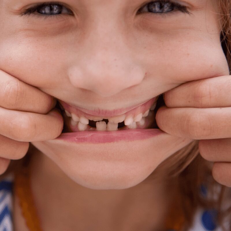 kid shows fractured teeth and signs of bruxism (1) kid shows fractured teeth and signs of bruxism