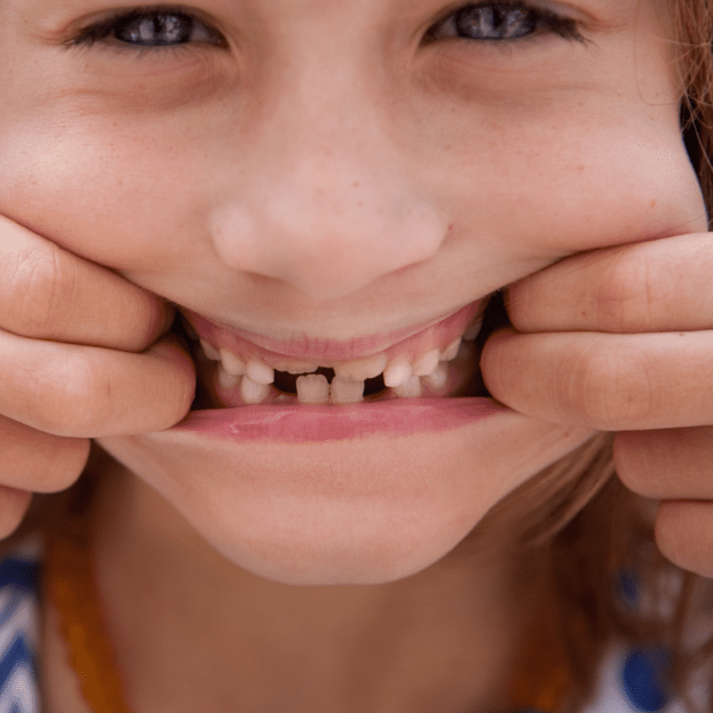 kid shows fractured teeth and signs of bruxism (1) kid shows fractured teeth and signs of bruxism