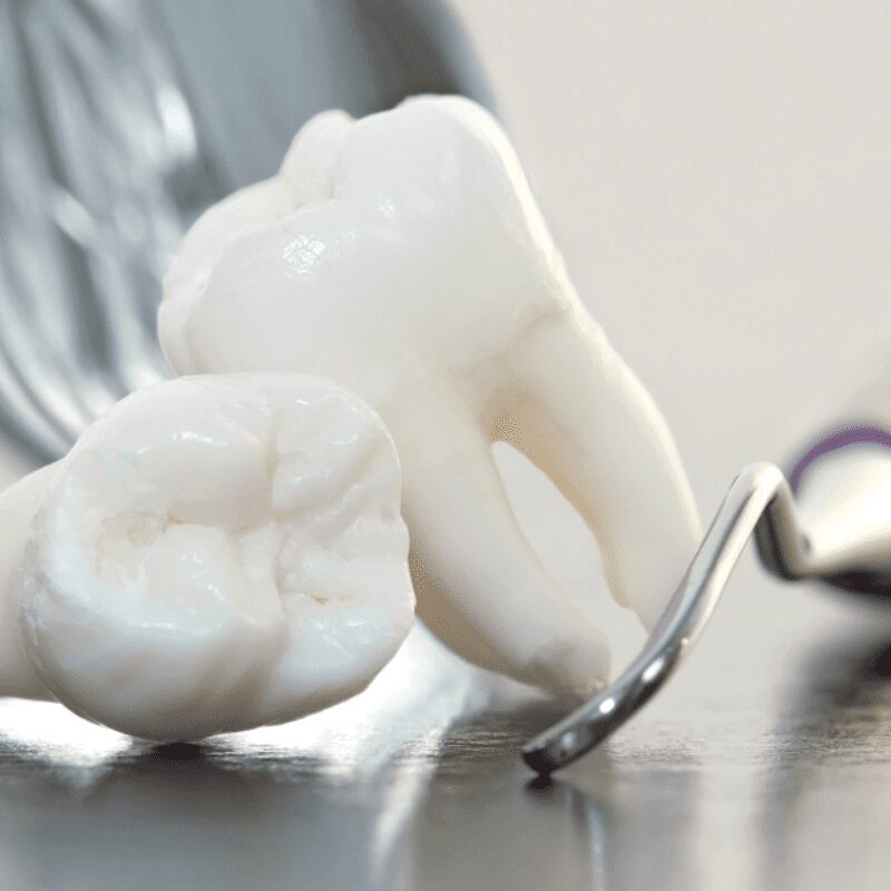 removal of wisdom tooth