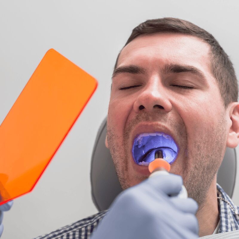 curing dental sealant