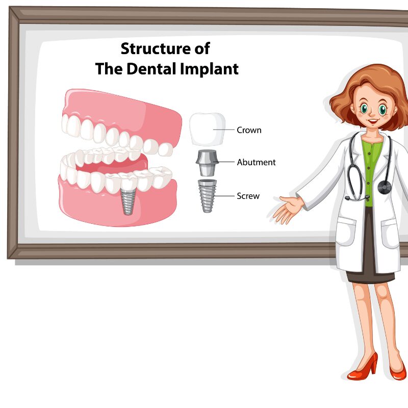 structure of dental implant animated structure of a dental implant