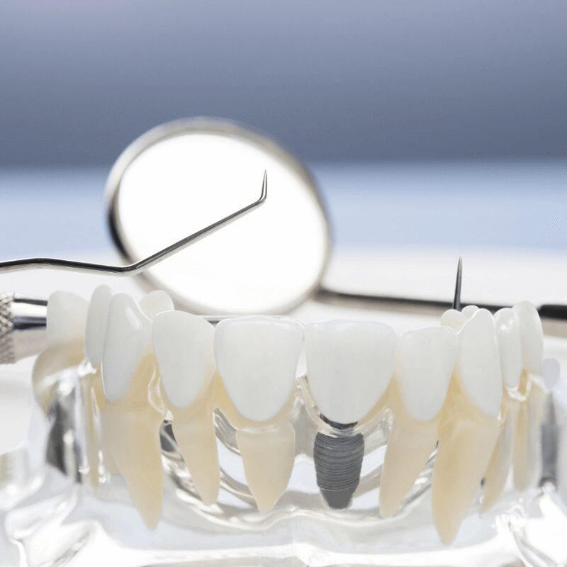 model of lower jaw with implant model of lower jaw with implant