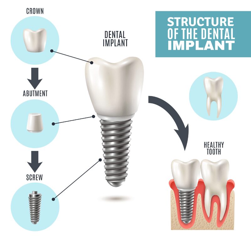 structure and componenets of dental implant structure and componenets of dental implant