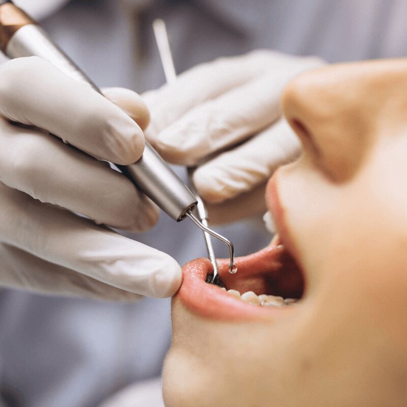 female patient , dental bonding for gaps female patient dental bonding for gaps