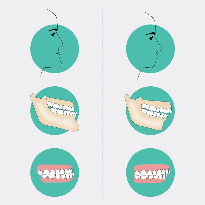 side view of overbite and underbite jaw side view of overbite and underbite jaw, symptoms of overbite