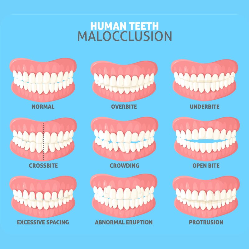 teeth malocclusion teeth malocclusion