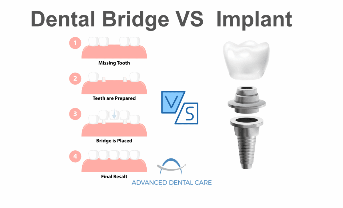 Dental Bridge vs Implant: Key Difference | Which is Right for You