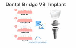 dental bridge vs implant
