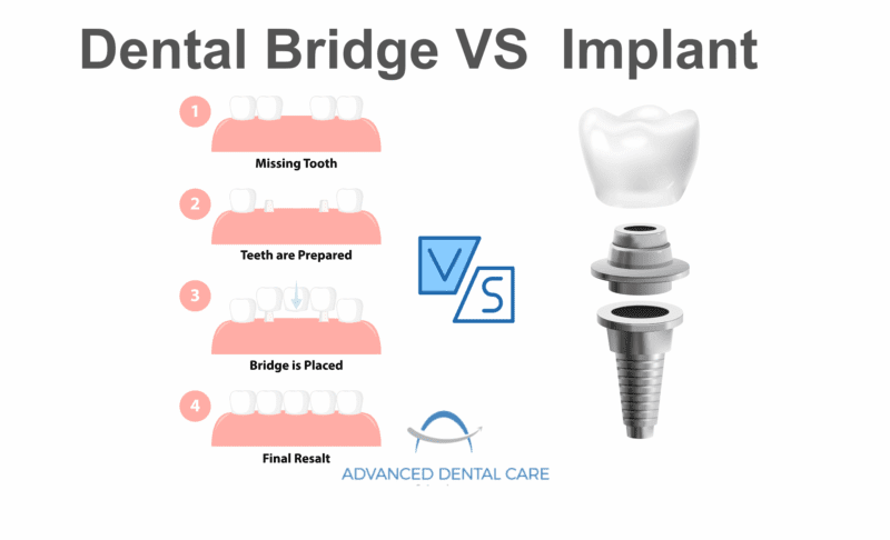 Dental Bridge vs Implant: Key Difference | Which is Right for You