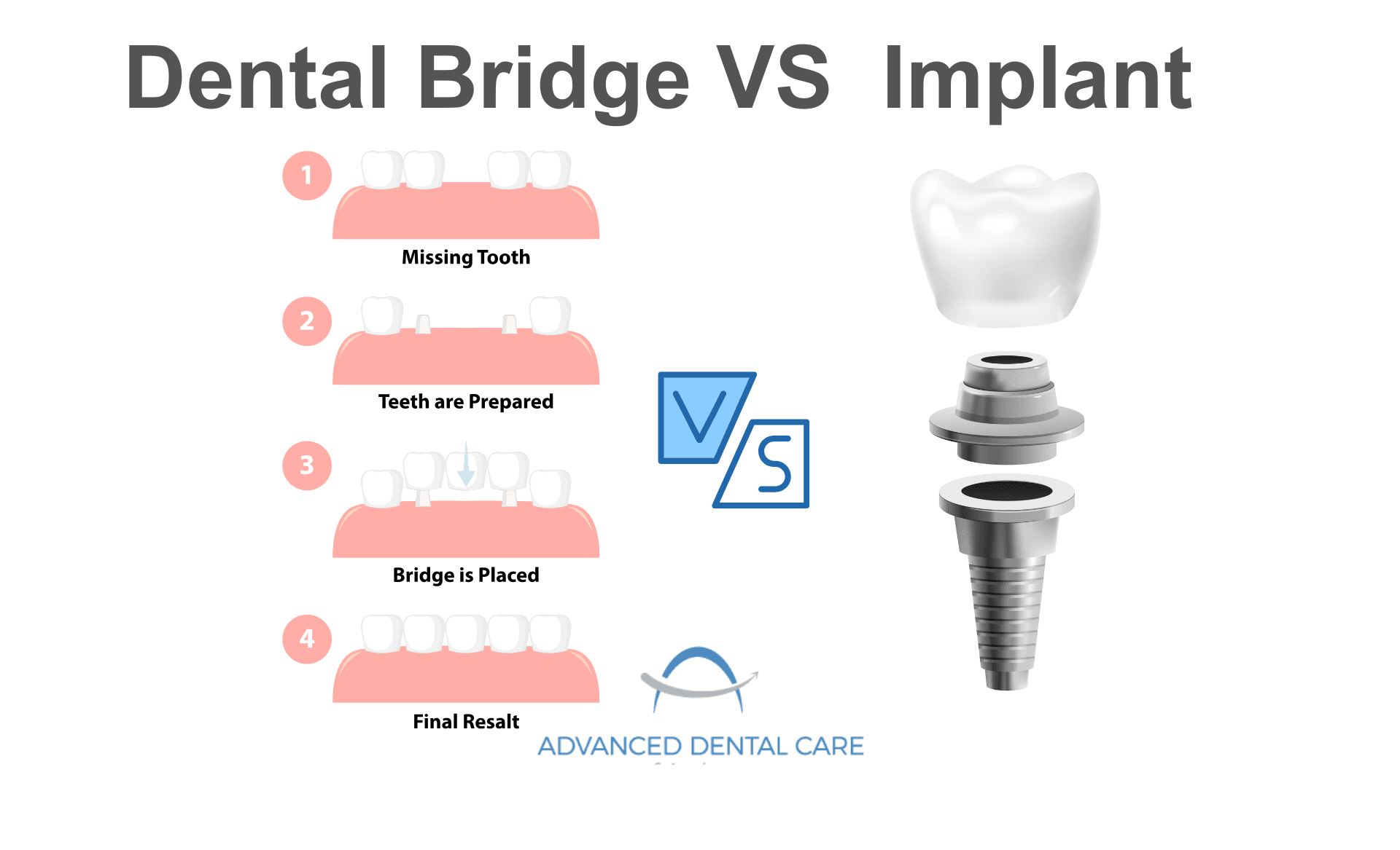 dental bridge vs implant