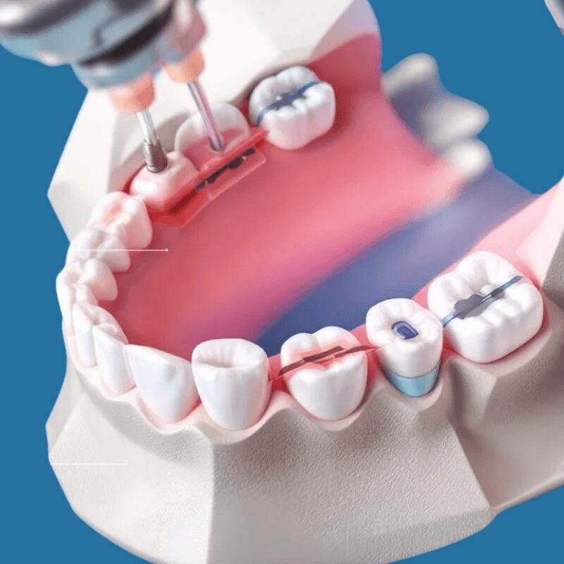 dental bridge