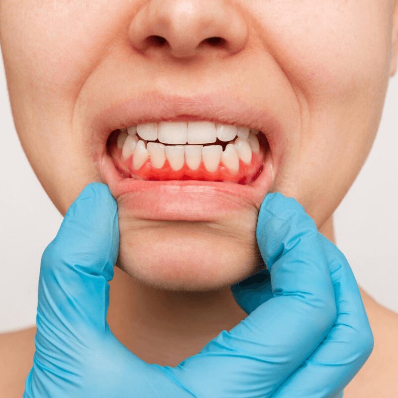 young woman having red swollen gums, vaping caused swollen gums