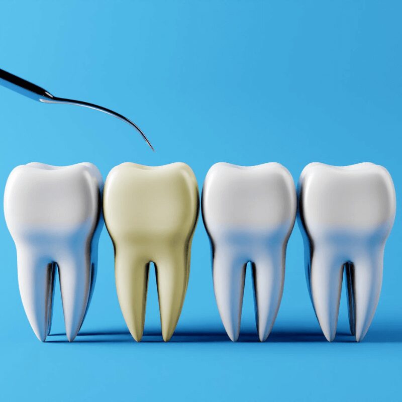 yellowish tooth between white teeth