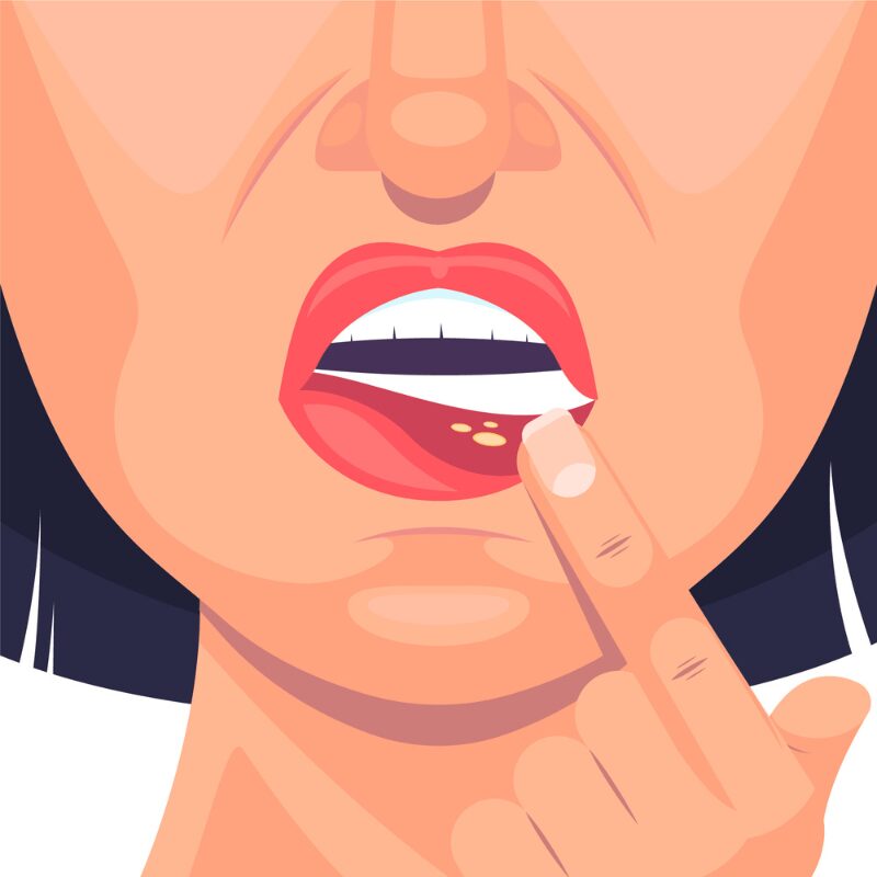 sore lips illustration