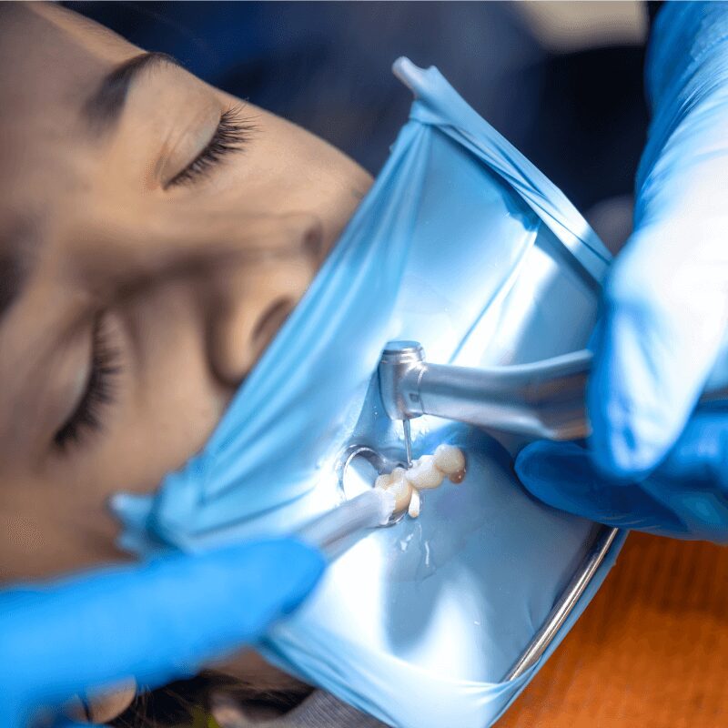 root canal procedure in process, rubber dam installed, wedge and ring placed between teeth