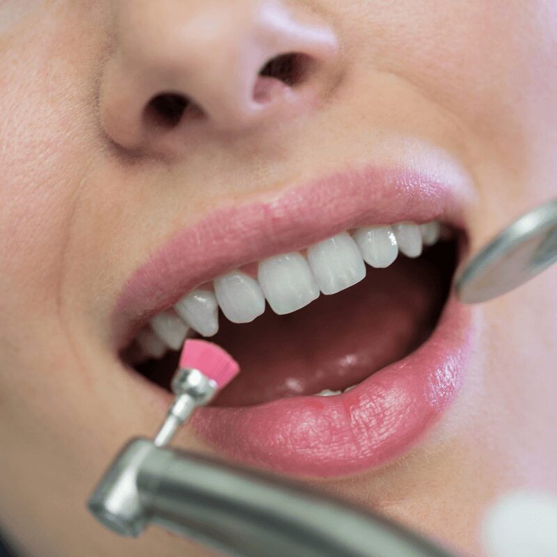 female patient getting her teeth polished after teeth cleaning for tartar removal