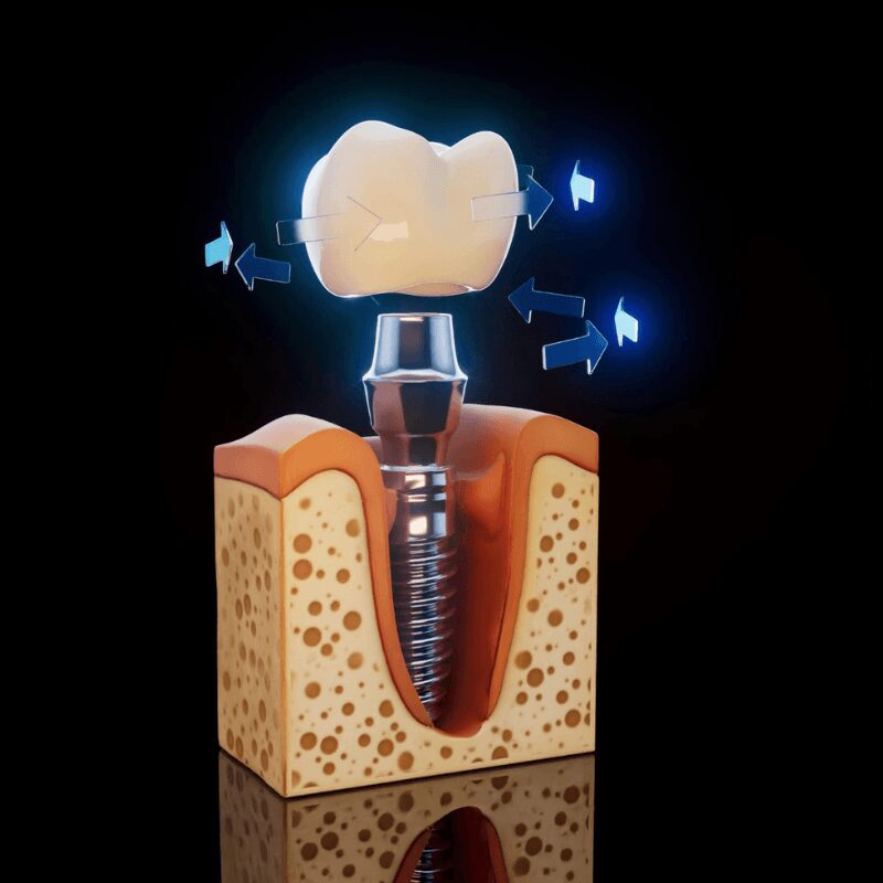 conceptual-3d-illustration-dental-implant-inside-jaw