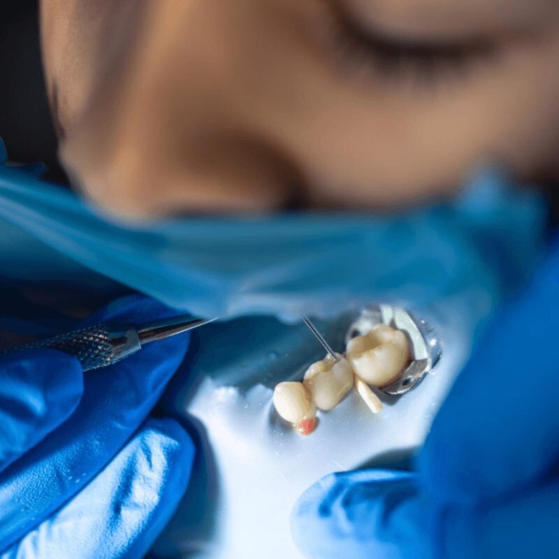 dentist-treats-childs-tooth-using-rubber-dam-closeup-tooth-treatment