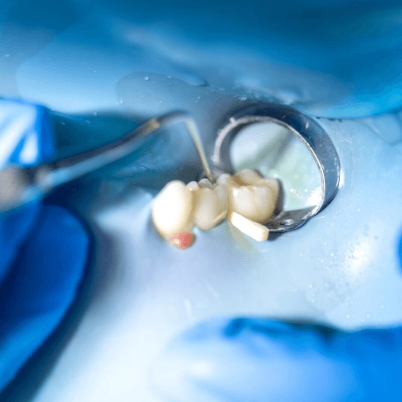 dentist-treats-tooth-using-rubber-dam-closeup-tooth-treatment