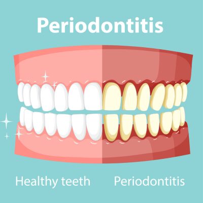 healthy teeth vs teeth with periodontitis healthy teeth vs teeth with periodontitis